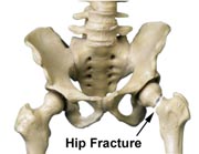 a fractured hip a fractured hip